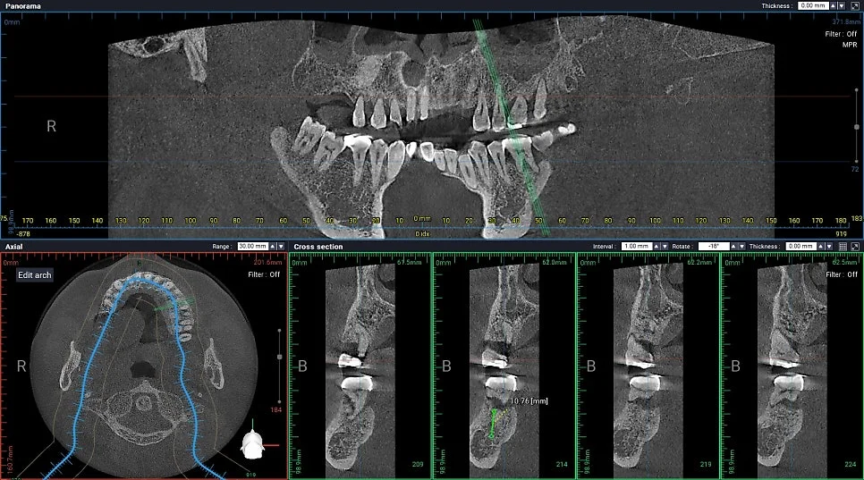 CBCT 어금니 뿌리 상태 시상면 영상