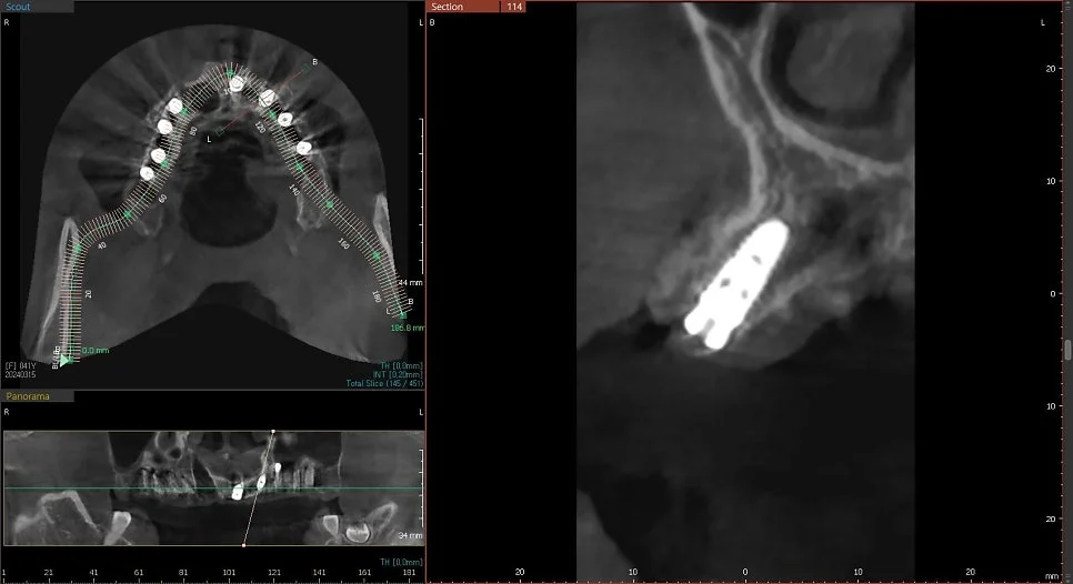 CBCT 4번 임플란트 위치 검증