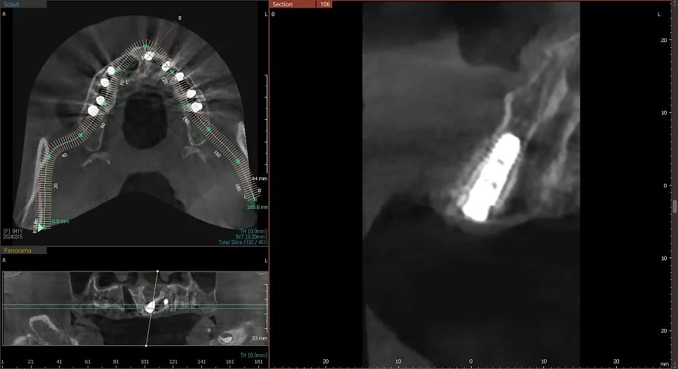 CBCT 5번 임플란트 위치 검증