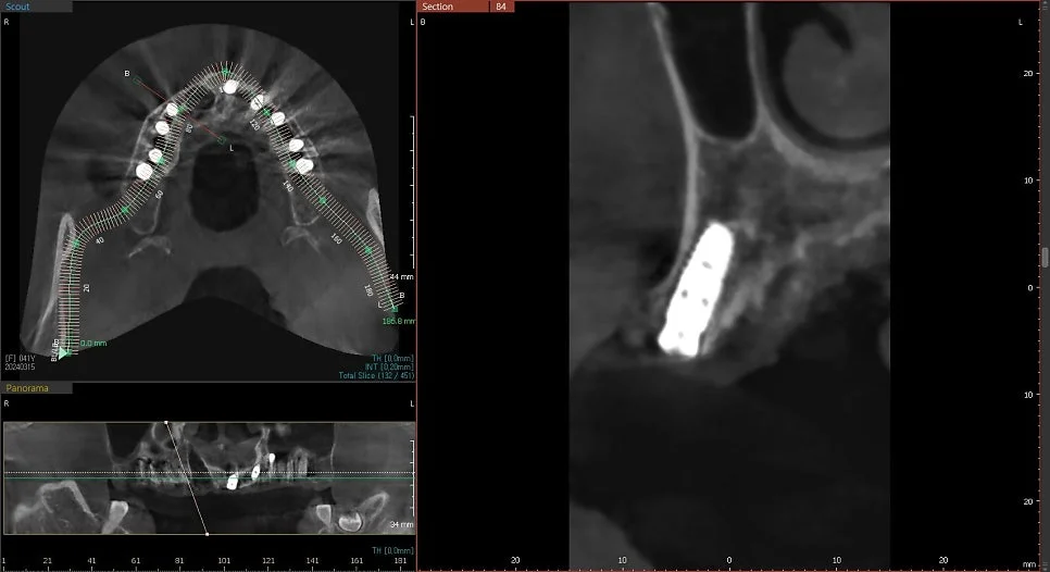 CBCT 6번 임플란트 위치 검증