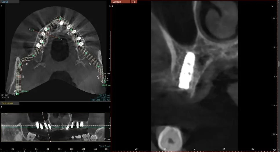 CBCT 7번 임플란트 위치 검증
