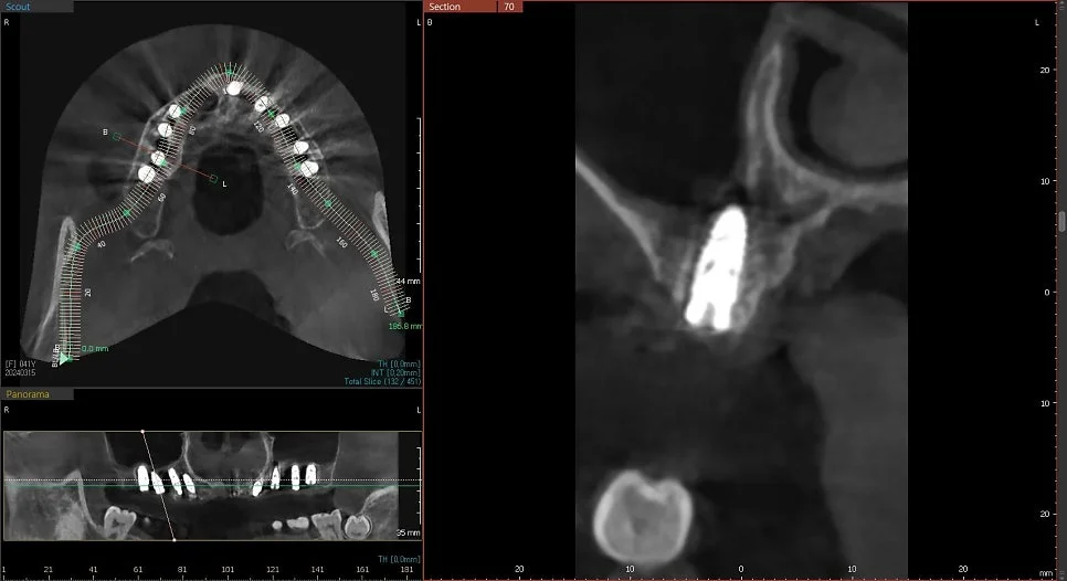CBCT 8번 임플란트 위치 검증