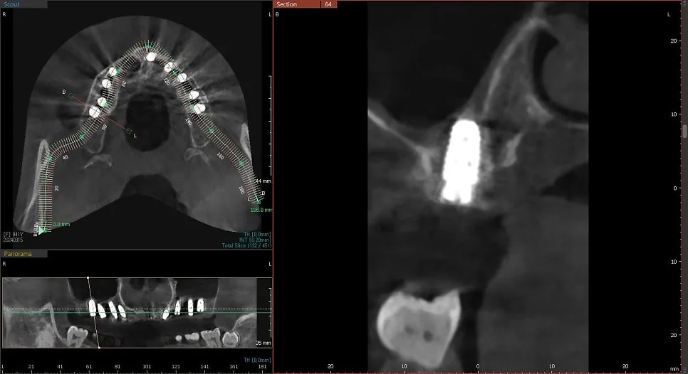 CBCT 9번 임플란트 위치 검증