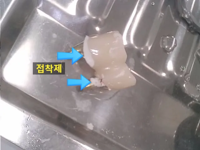 임플란트 보철물 접착제 제거 과정 시각 자료