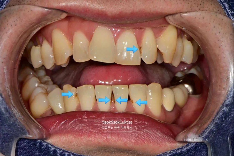 치경부 마모증 치료 전 스케일링 착색 제거 후 깨끗한 치아