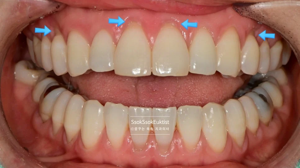 치경부 마모증 임상 사진 잇몸 경계 치아 패임 진단