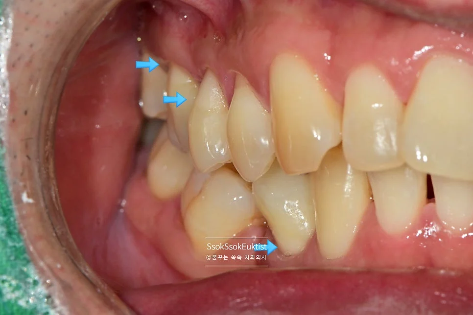 치경부 마모증 GI 충전 완료 후 자연스러운 결과 1