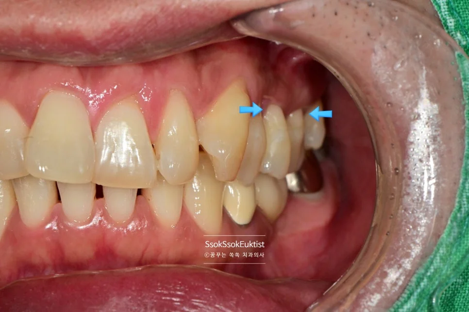치경부 마모증 GI 충전 완료 후 측면 결과 2