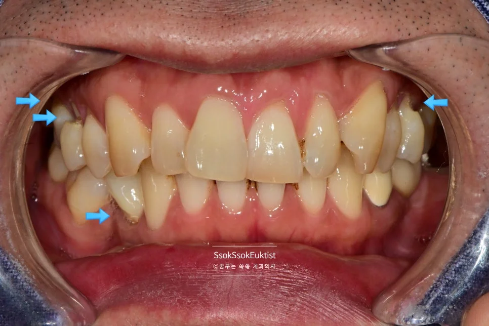 치경부 마모증 GI 치료 전 V자 U자 혼합 형태 1