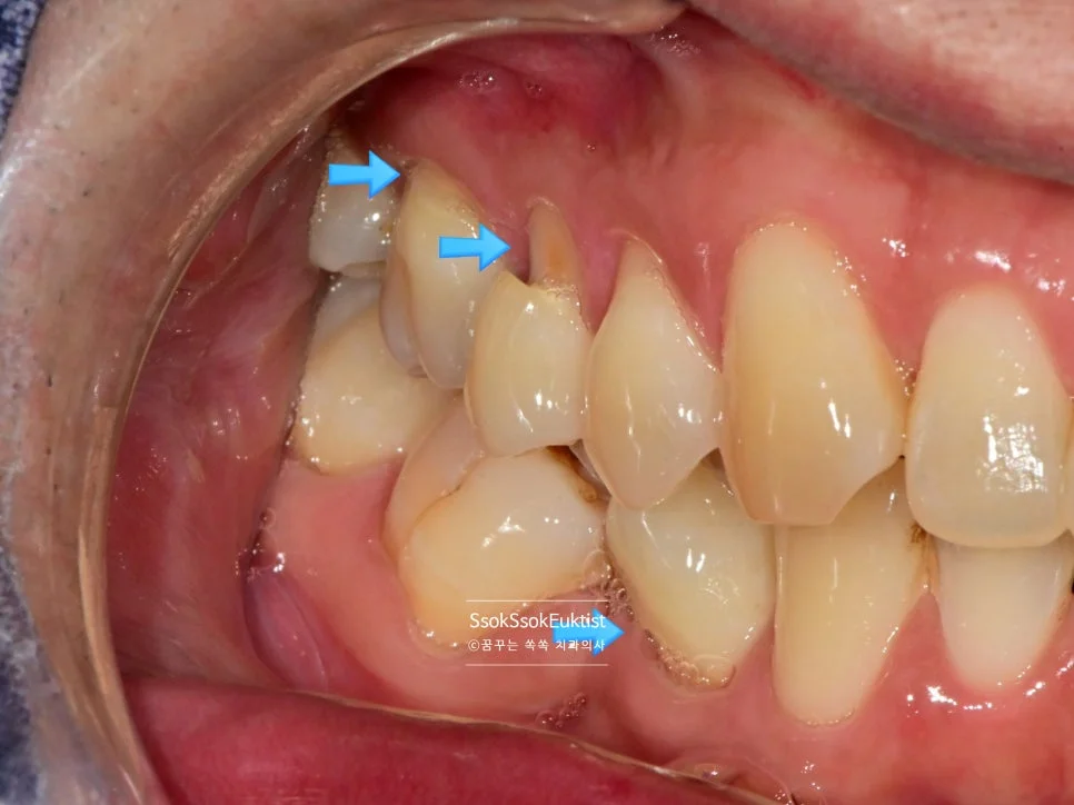 치경부 마모증 GI 치료 전 V자 형태 2