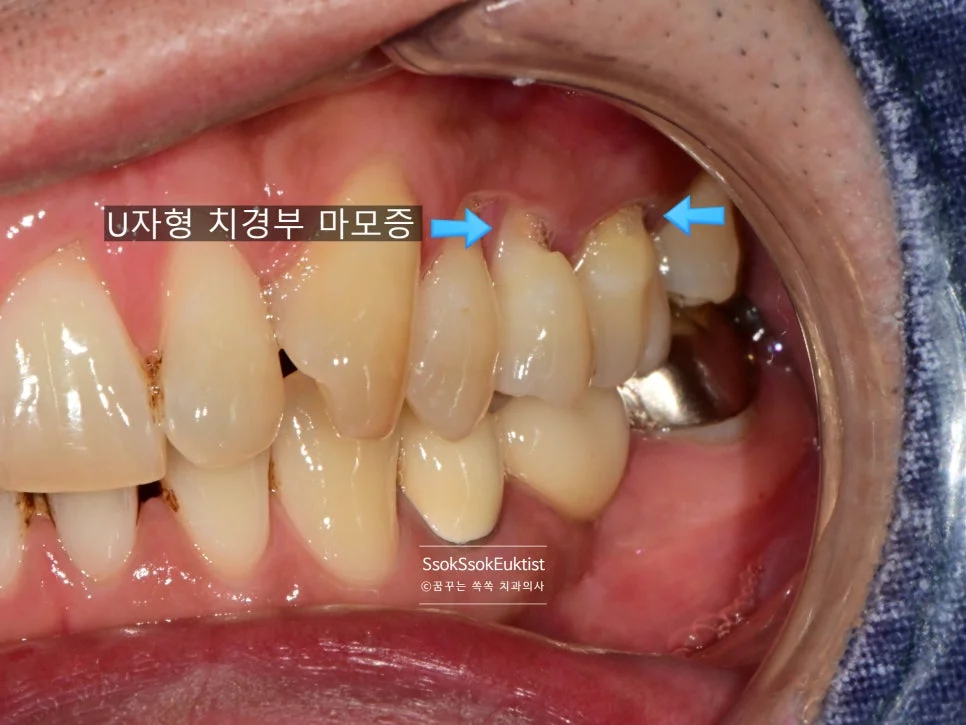 치경부 마모증 GI 치료 전 측면 3