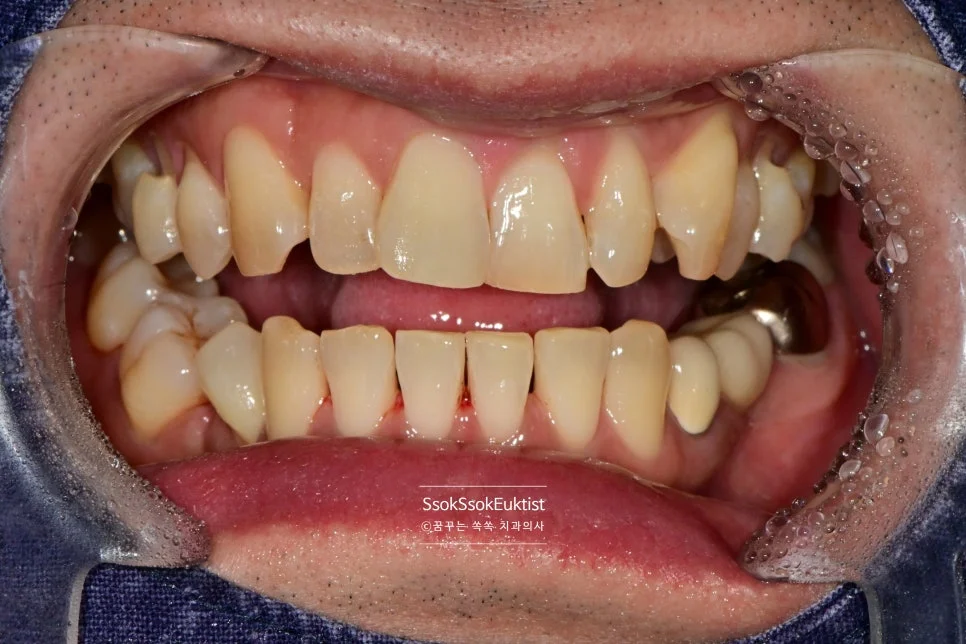 치경부 마모증 GI 글라스아이오노머 충전 중 시술 과정