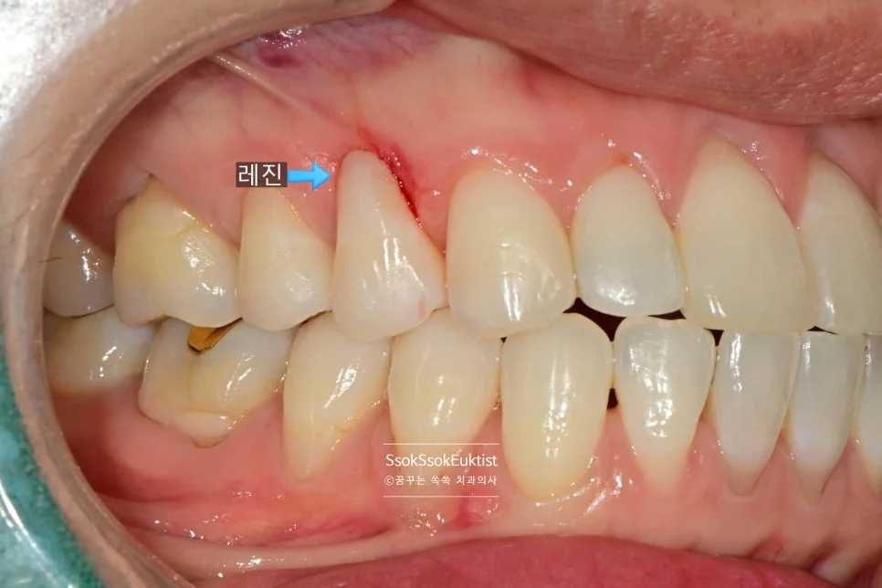 치경부 마모증 레진 GI 혼합 치료 후 결과 1
