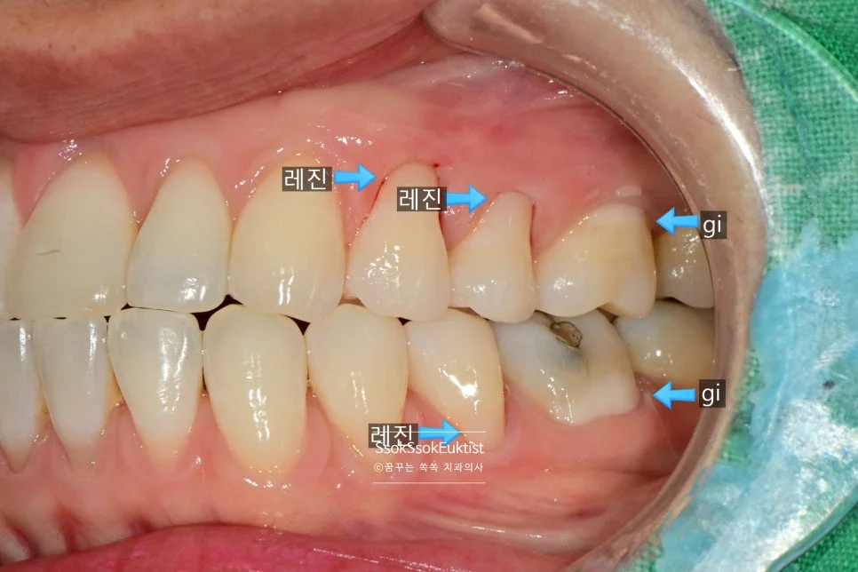 치경부 마모증 레진 GI 혼합 치료 후 결과 2