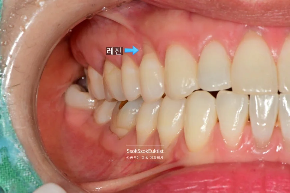치경부 마모증 레진 GI 혼합 치료 전 측면 2