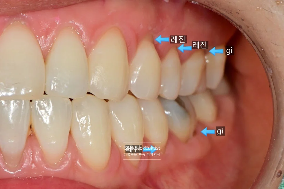 치경부 마모증 레진 GI 혼합 치료 전 3