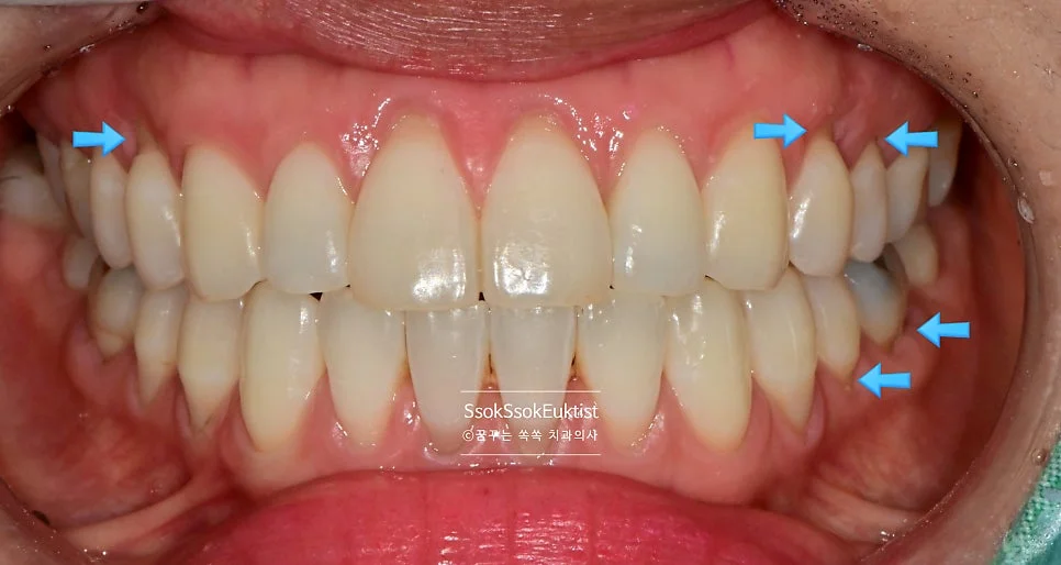 치경부 마모증 레진 GI 혼합 치료 전 화살표 치료 계획
