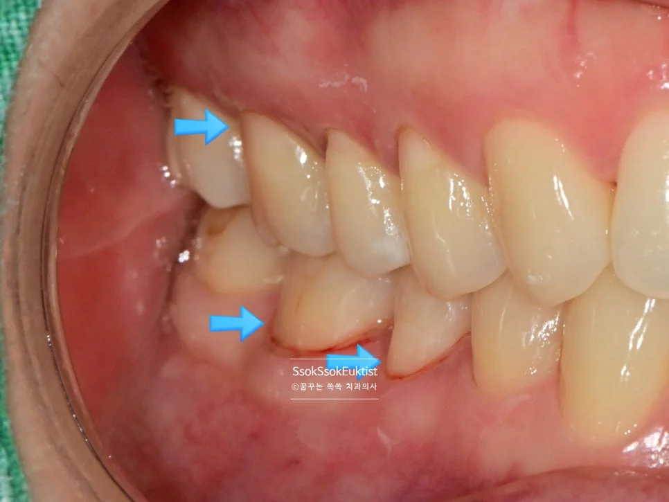 치경부 마모증 레진 치료 후 자연스러운 색상 1