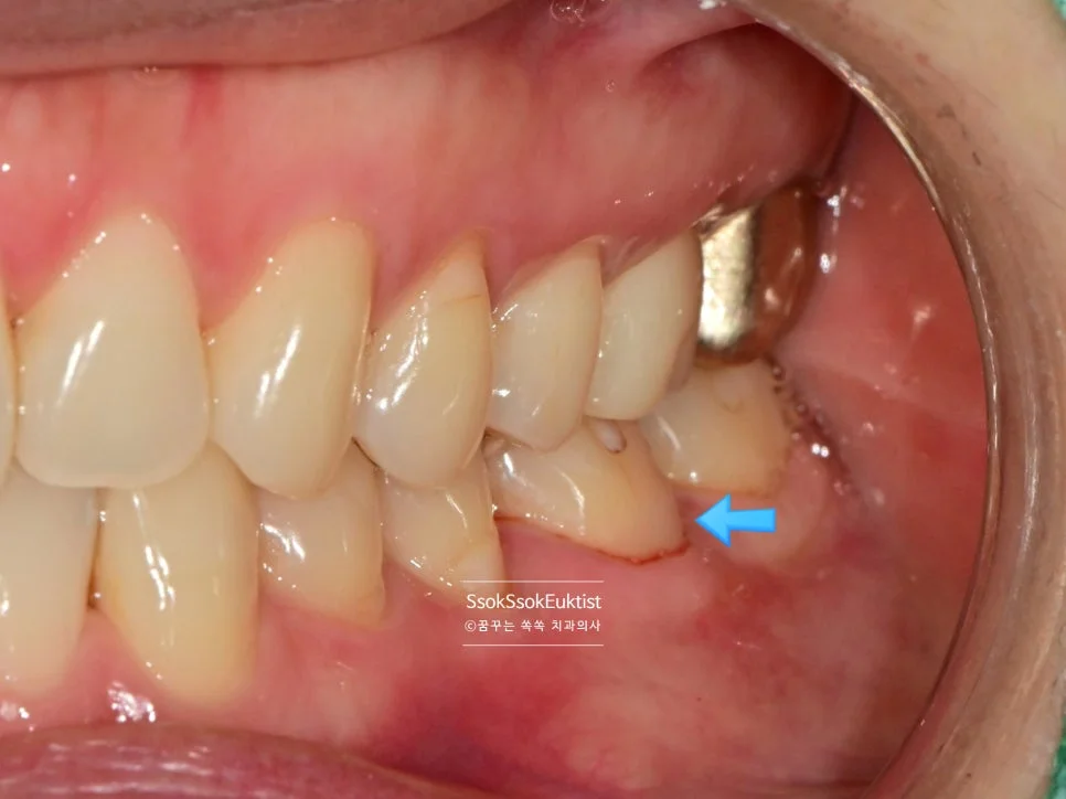 치경부 마모증 레진 치료 후 자연스러운 색상 측면 2