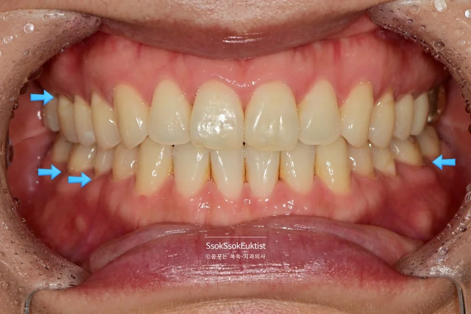 치경부 마모증 레진 치료 전 V자 형태 패임 1