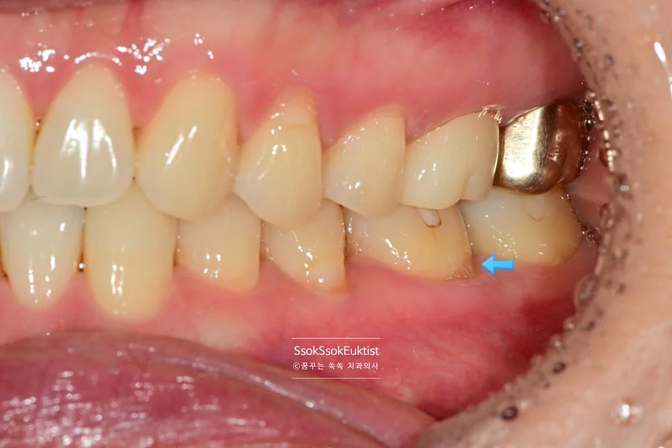 치경부 마모증 레진 치료 전 하악 전치부 3