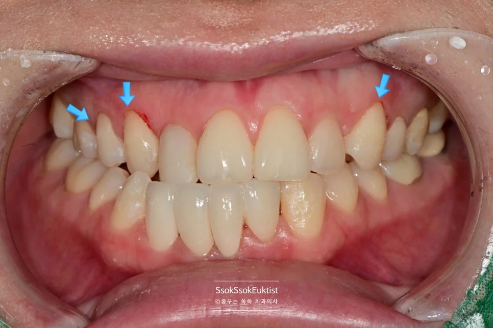 치경부 마모증 레진 치료 완료 후 자연스러운 결과 화살표 표시