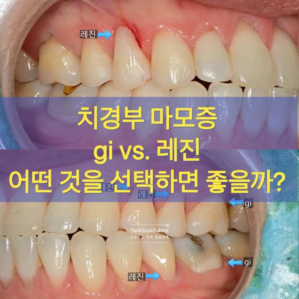 치경부 마모증 치료 GI vs 레진 비교 타이틀 이미지