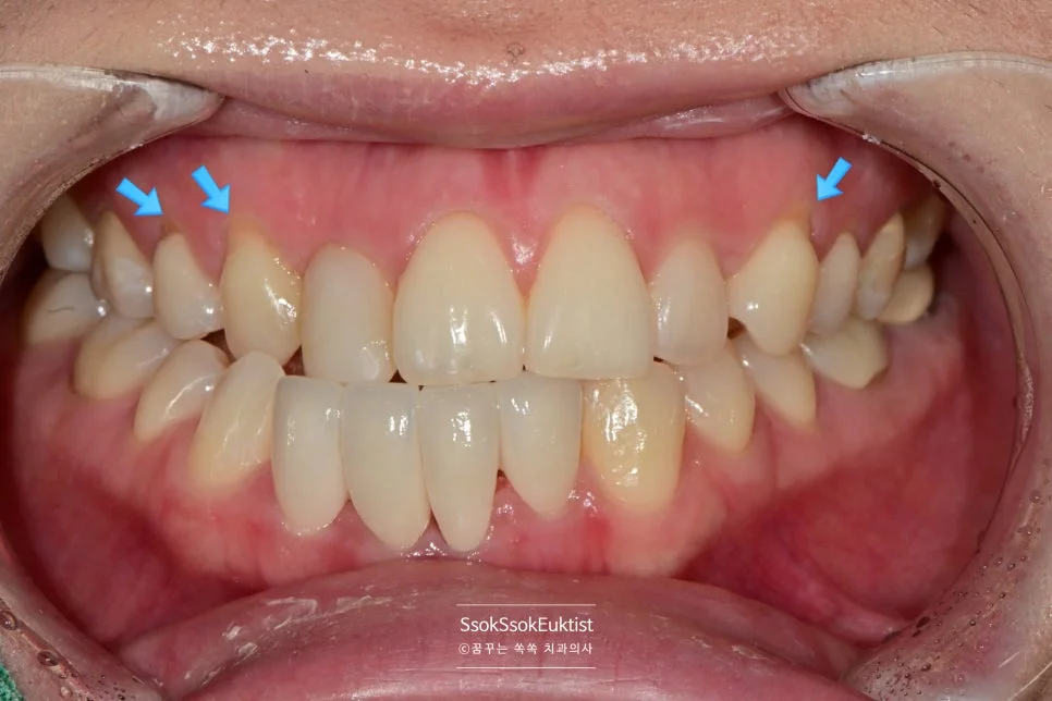 상악 치경부 마모증 부위 화살표 표시 잇몸 경계 패임