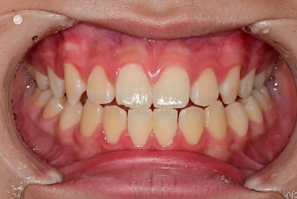 아이 앞니 파절 치료 전 정면 전체