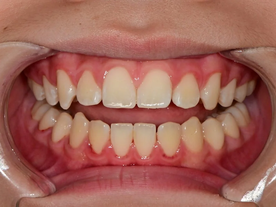 아이 앞니 파절 레진 치료 후 정면 전체