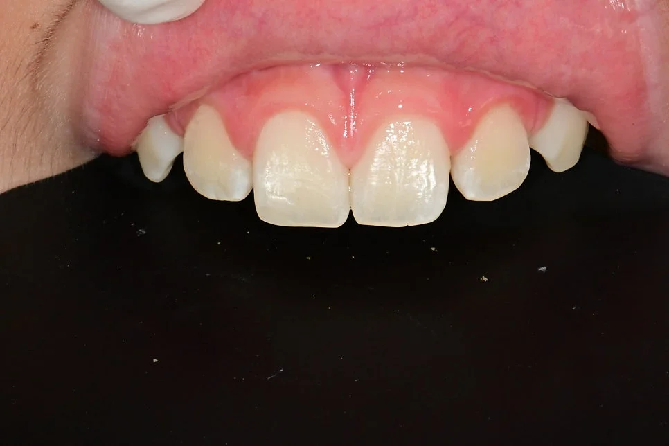 아이 앞니 파절 레진 치료 후 클로즈업