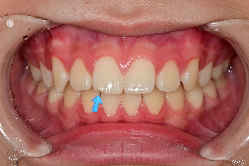 아이 앞니 파절 치료 전 정면 화살표