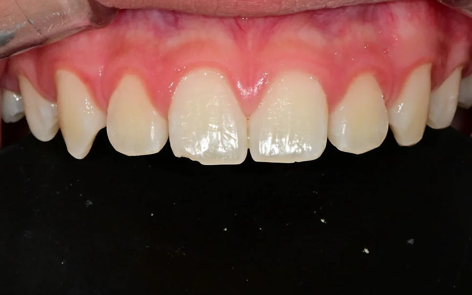 아이 앞니 파절 부위 클로즈업