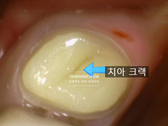 치아 균열선 확대 촬영