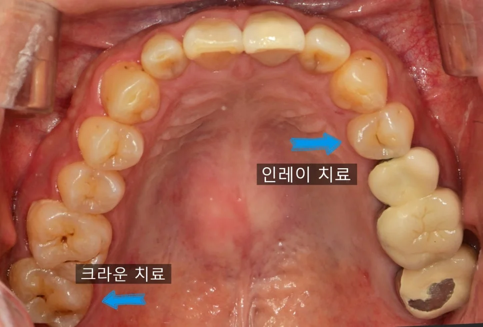 상악 제2대구치 크랙 투스 임상 사진