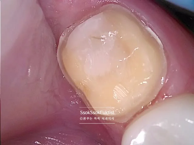 양쪽 제2대구치 크라운 삭제 후 파노라마 X-ray