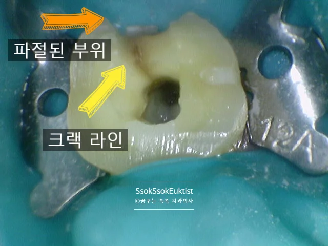 왼쪽 제2대구치 신경치료 완료 후 구내사진