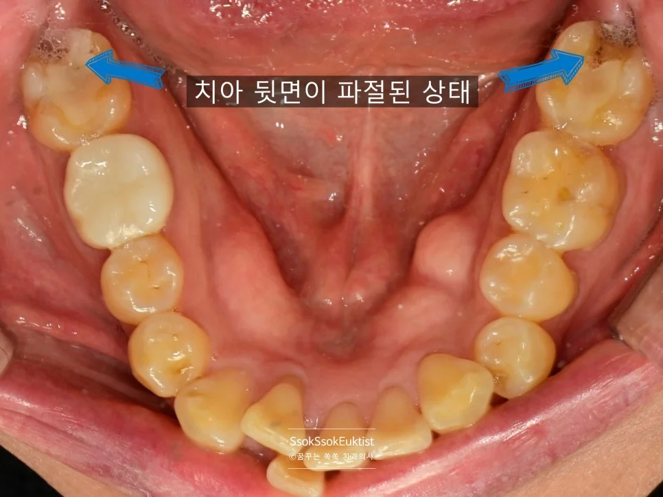 왼쪽 제2대구치 확대 사진 깊숙한 치아 크랙 파란 화살표