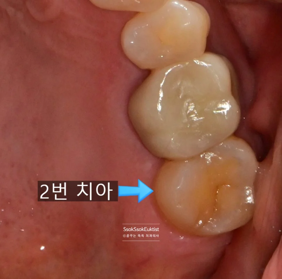 2번 치아 균열 크라운 삭제 사진