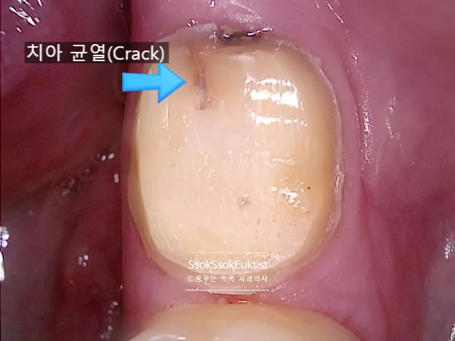 신경치료 후 크라운 준비 레진 보호 구내사진