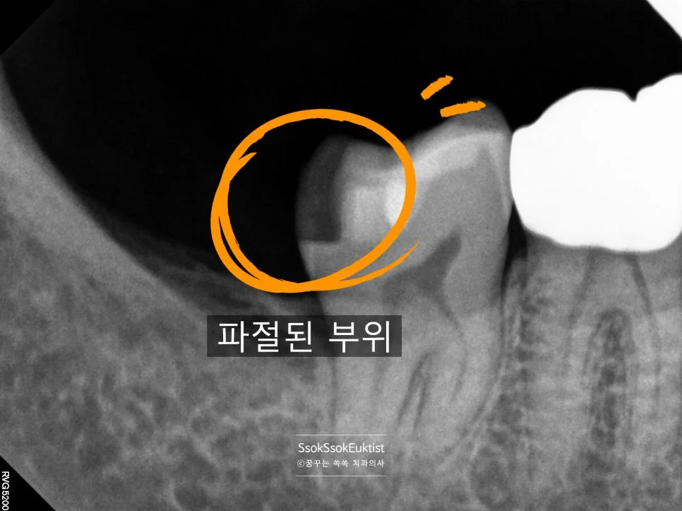 오른쪽 제2대구치 X-ray 파절 부위 신경관 미도달 오렌지 원 표시