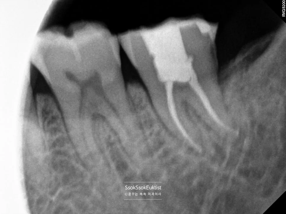 왼쪽 제2대구치 신경치료 완료 근관충전 X-ray 뿌리끝까지 충전
