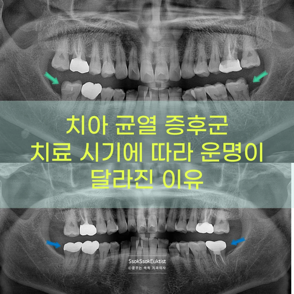 치아 균열 증후군 인포그래픽 치료 시기에 따라 운명이 달라진다