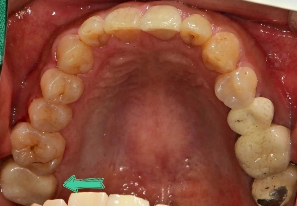 크라운 인접 치아 적합성 확인