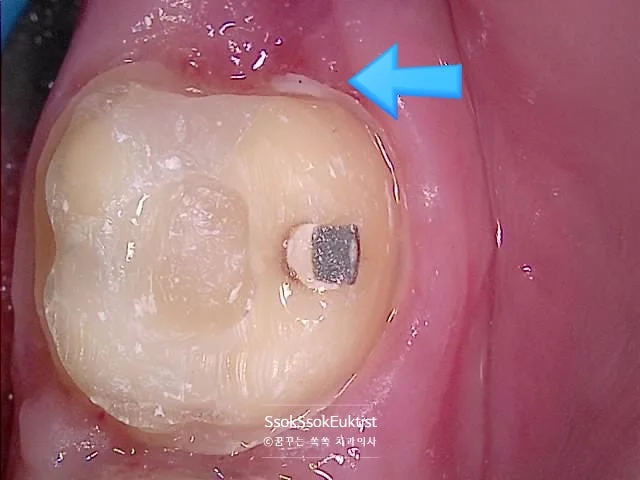 크라운 치아 삭제 깊은 충치 과정