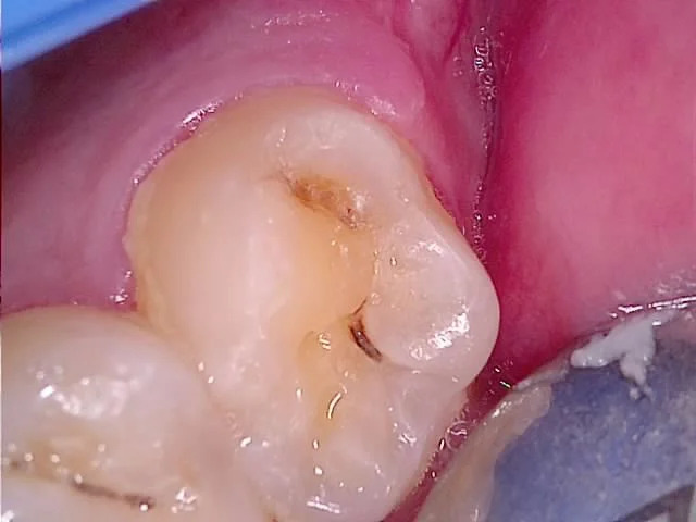 크라운 치관확장술 지대치 형성 과정