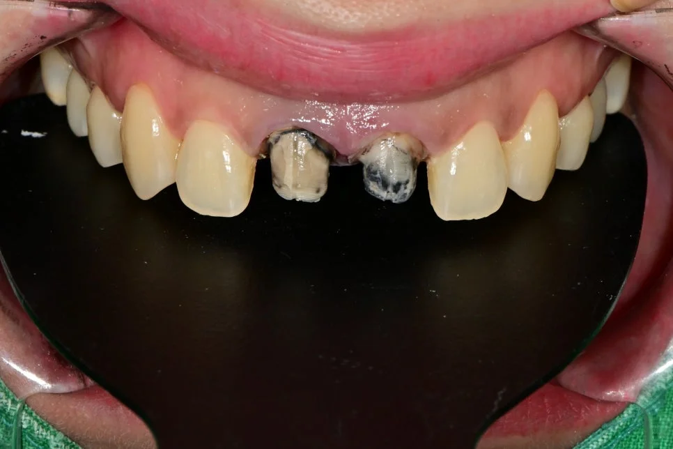 크라운 제거 후 치아 내부 변색 오염 상태
