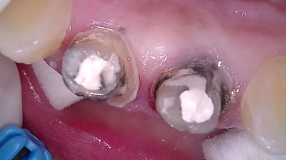 크라운 제거 후 신경관 내부 오염 근접 사진