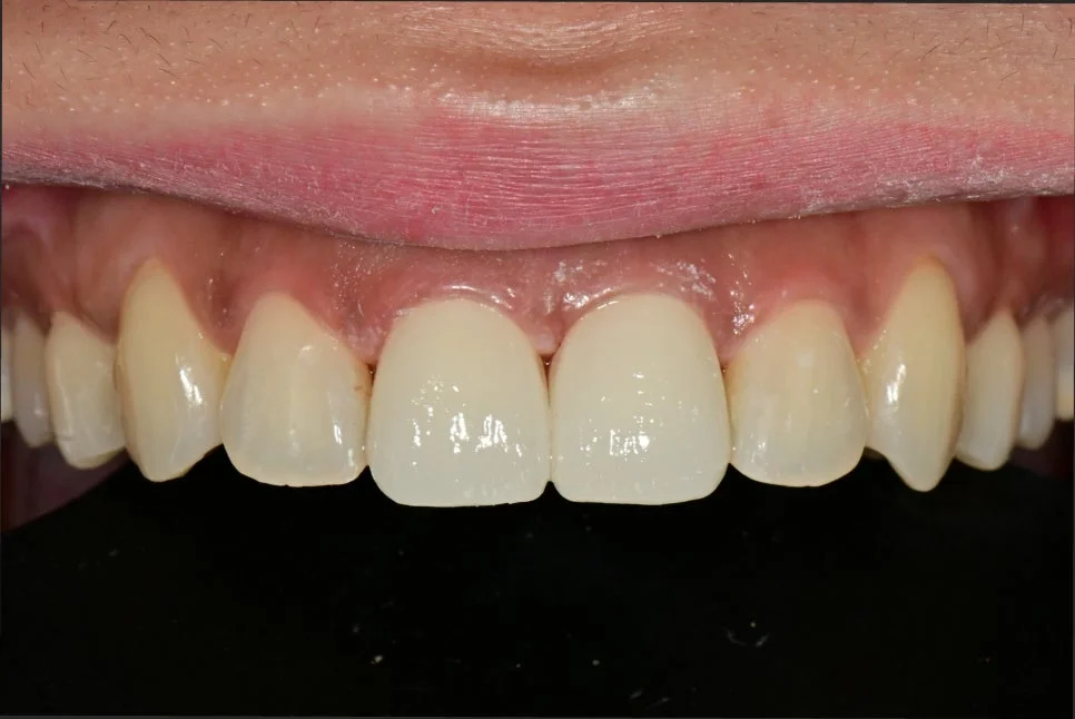 전치부 크라운 세팅 완료 심미 결과