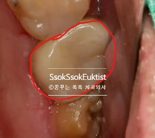 크라운 치료 설명 이미지